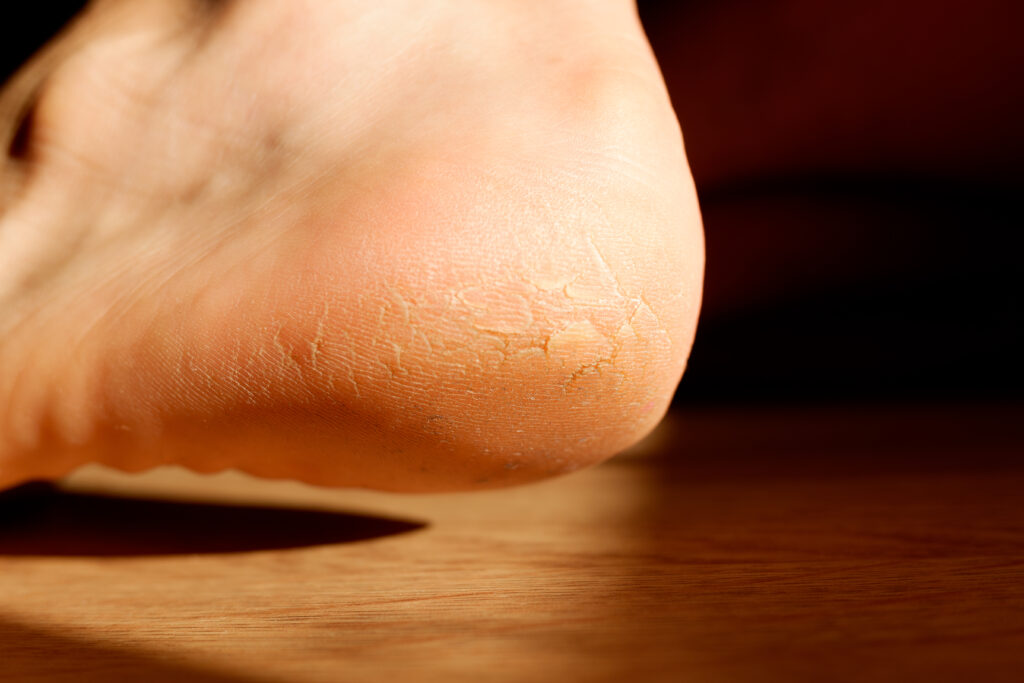 cracked and dry heel of the foot skin.
