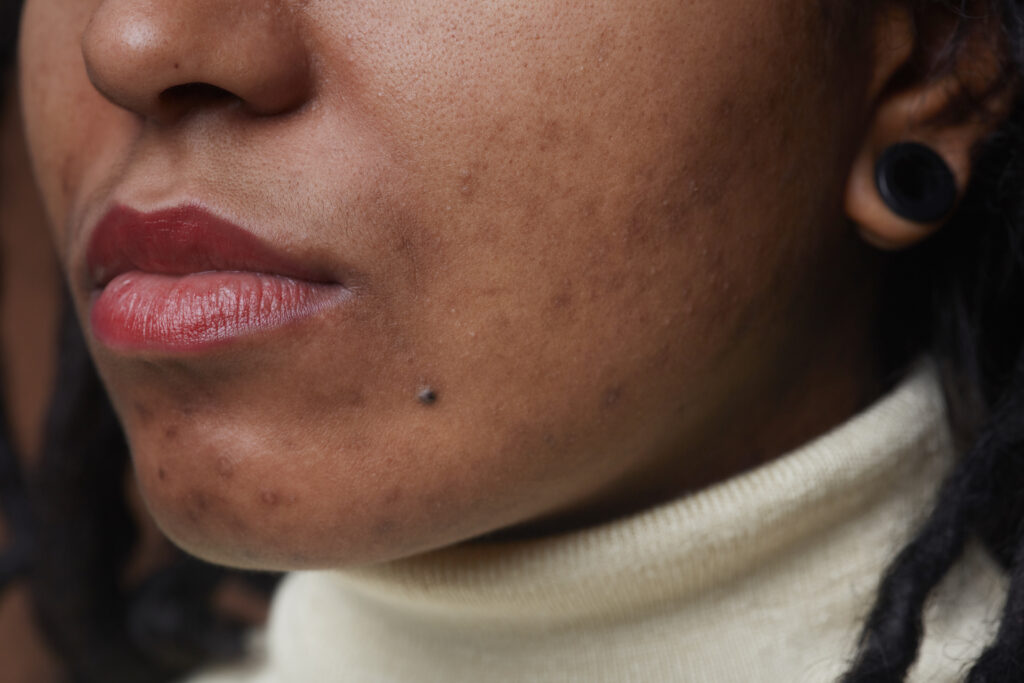 acne scars close up